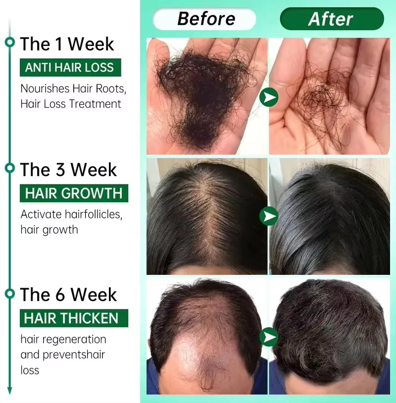 Sérum de croissance des cheveu - Ingrown Hair Serum avis et prix
