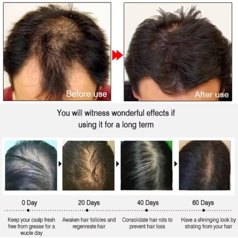 Sérum de croissance des cheveu - Ingrown Hair Serum avis et prix